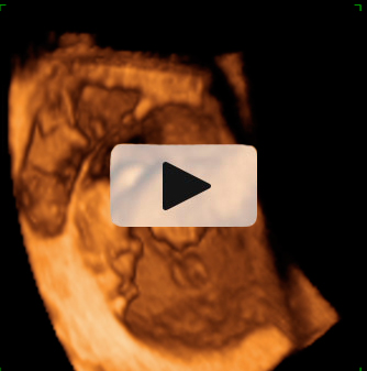 Trillizos de 10 semanas en ecografía 4D