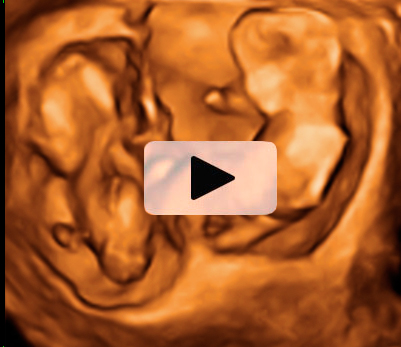 Gemelos de 12 semanas moviendo sus extremidades