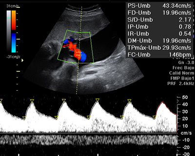 Ecografía doppler del cordón umbilical
