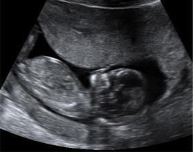 Feto de 13 semanas de embarazo: corte sagital