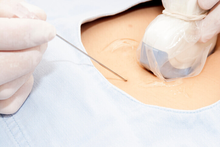 Amniocentesis en la 15 semanas de desarrollo del feto