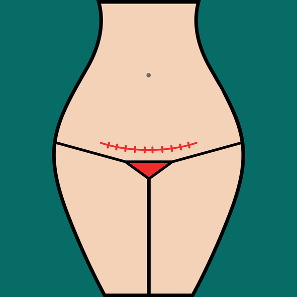 Recuperación física tras una cesárea