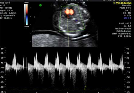 regurgitacion tricuspidea