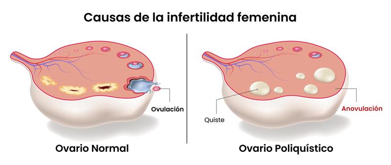 Los ovarios poliquísticos