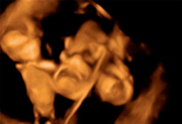 Ecografía semana 12: Trillizos en bolsas diferentes