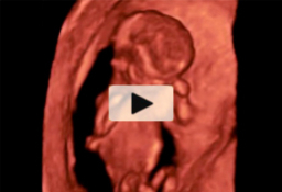 ecografía semana 13 Feto en rotación