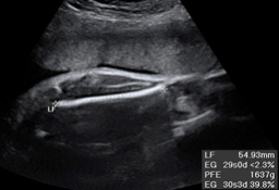 Ecografía del tercer trimestre: tamaño y peso fetales