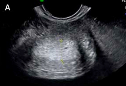 Ecografía del embrión semana a semana: cómo es