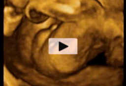 Ecografía 4D Semana 20 - Genitales del sexo masculino